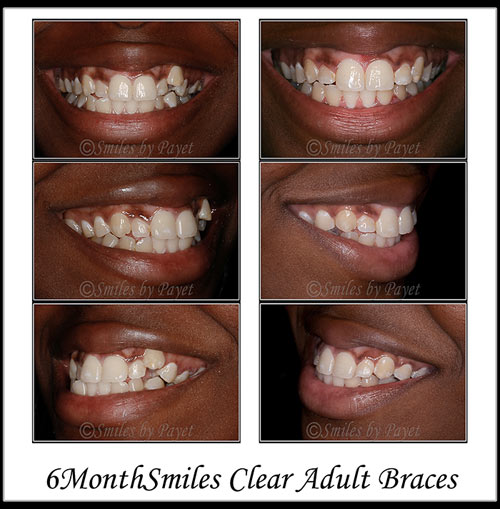 braces before and after braces photos. 6MonthSmiles Invisible Braces