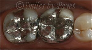 Silver fillings Charlotte Pineville Matthews dentist