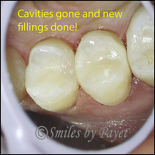 Fillings why hurt do How Long