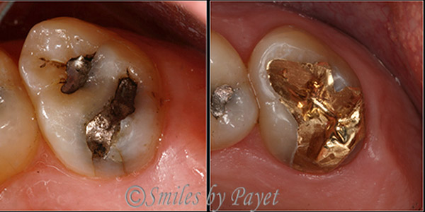 gold tooth filling