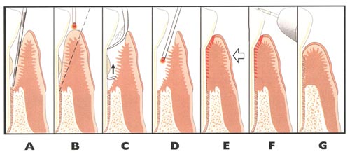 The steps of LANAP that experienced Charlotte dentist Dr. Payet performs to treat gum disease effectively and comfortably
