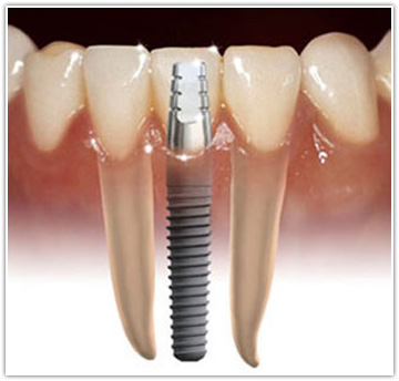 Picture of a dental implant and porcelain crown