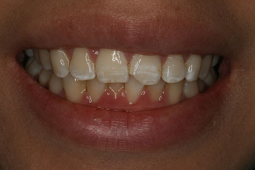  Chipped Tooth Filler