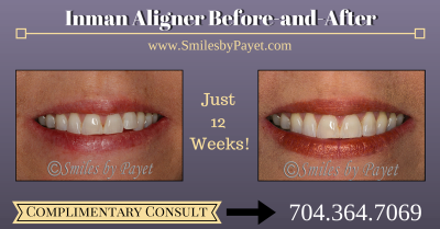 Inman Aligner Before-After