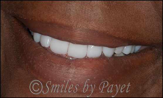 Beautiful premium dentures, Charlotte dentist, Lake Norman, Matthews, Pineville, Rock Hill