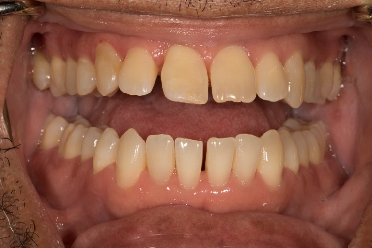 cavities-gum-disease-are-not-inevitable-charlotte-dentist