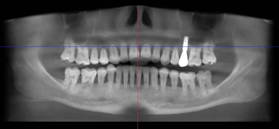 inflammatory root resorption after braces