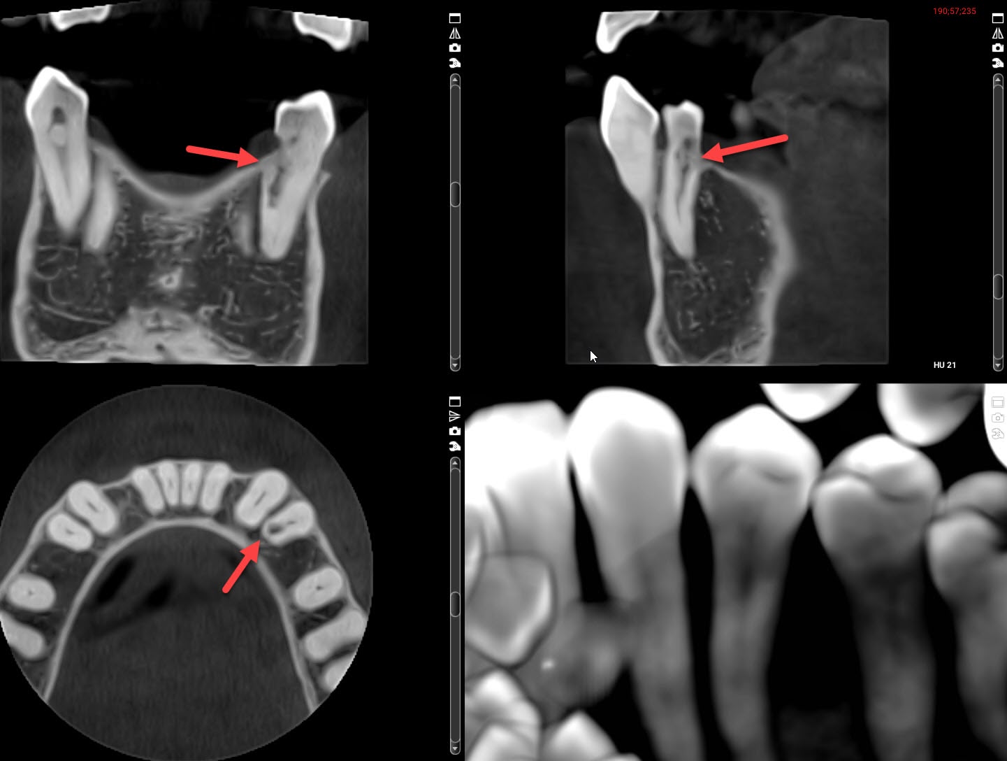 3D cone beam x-ray views, internal resorption lower front tooth