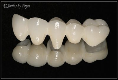 dental crowns bridges charlotte dentist
