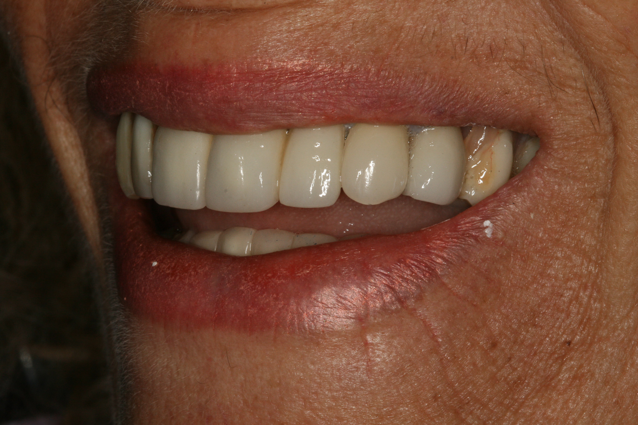 Repairing A Broken Dental Bridge Charlotte Cosmetic Dentist