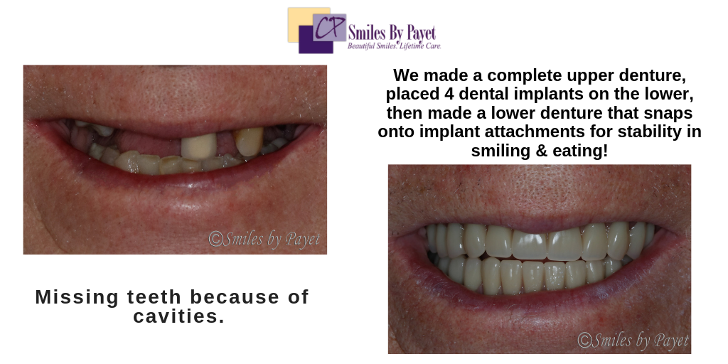 Implant Supported Overdentures