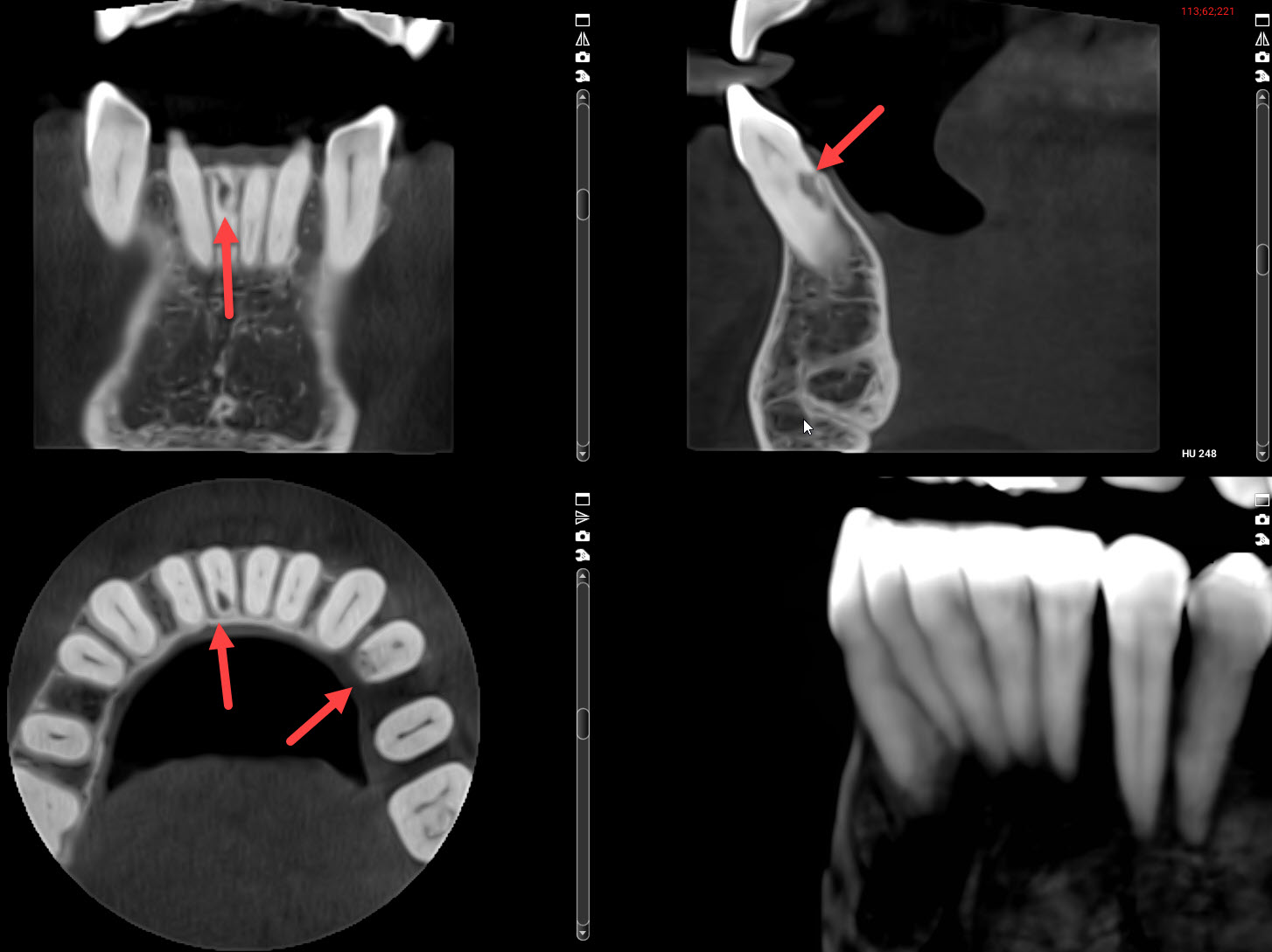 what-is-root-resorption-can-it-be-fixed-charlotte-root-canal-dentist