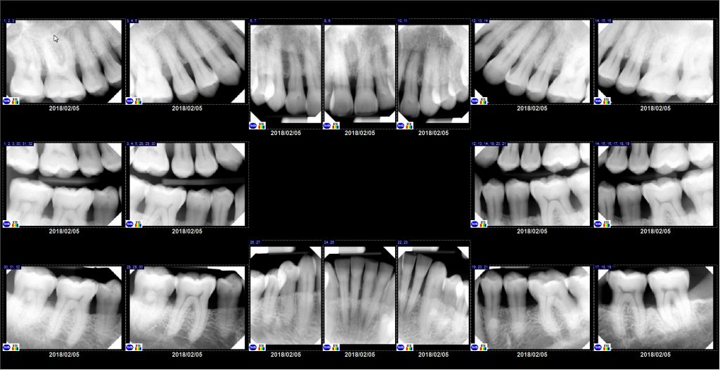 Dental X-rays: Why, Which, & When? - Digital X-rays - Charlotte Dentist