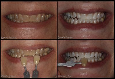 Teeth Whitening | Charlotte Cosmetic Dentist | Laser Teeth Bleaching