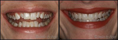 adult braces cosmetic dentistry