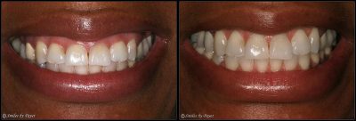 gummy smile cosmetic gum surgery charlotte