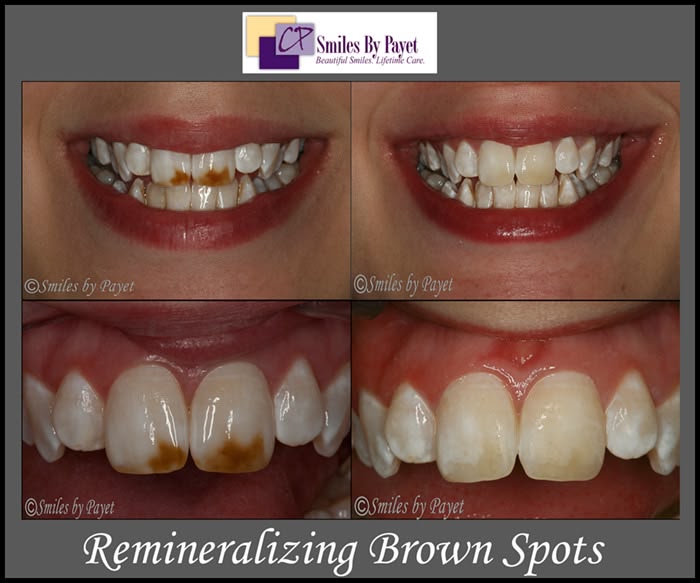 Cosmetic dentistry with teeth whitening is affordable and easy Brown spots on teeth can be whitened by remineralizing the teeth.