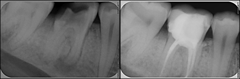 Root Canal Therapy before-after x-ray