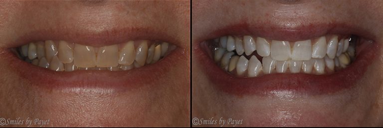 Teeth Whitening before after
