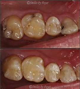 Dental Fillings
