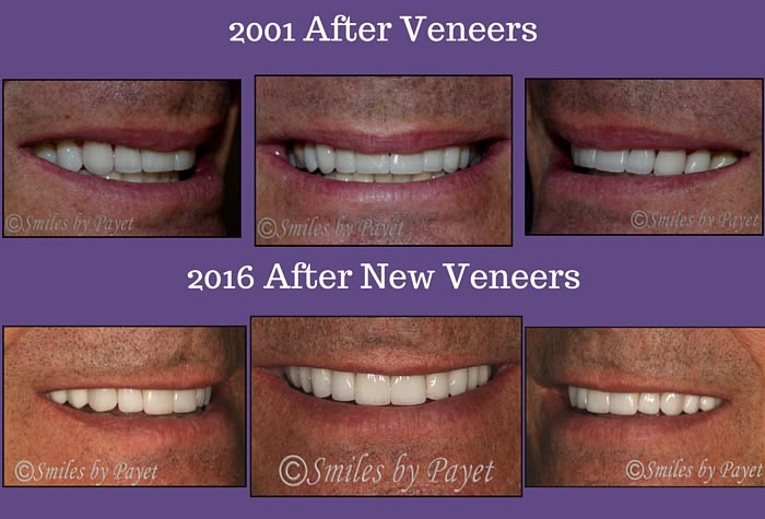 Before and After Veneers by Charlotte cosmetic dentist Dr. Payet