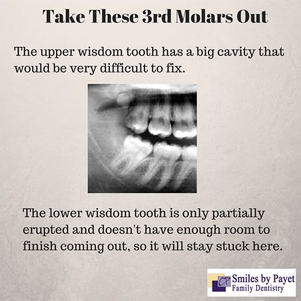 Reasons wisdom teeth need to be extracted