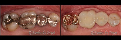 gold onlay porcelain dental crown