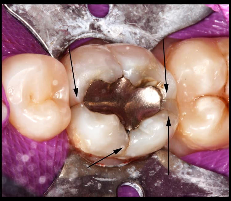 teeth-with-cracks-1 What does a cracked tooth look like