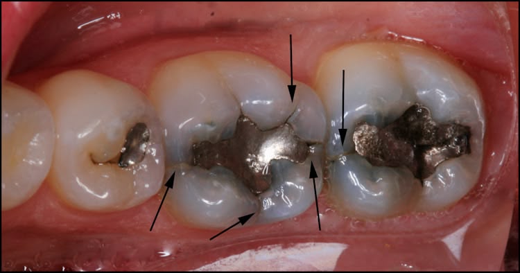 teeth-with-cracks how does it feel if your tooth is cracked